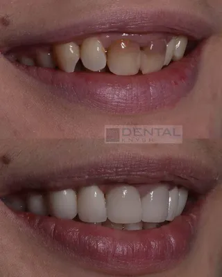 Виниры До После | Стоматология DentalKnysh Львов