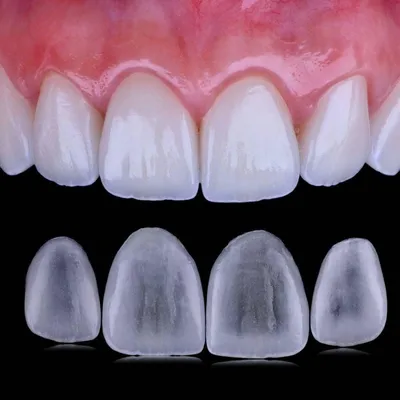 Лучшие виниры: виды и особенности накладок на зубы - Интернет-журнал «PRO  Здоровье» 🏥