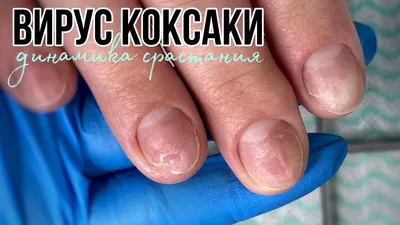 Вирус КОКСАКИ | динамика роста ноготков - YouTube