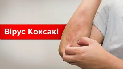 Вирус Коксаки: симптомы, лечение и пути передачи