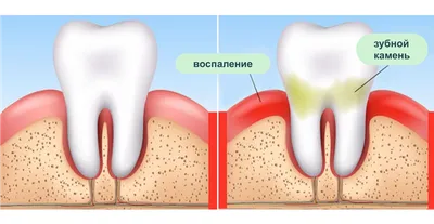 Катаральный гингивит: причины, формы, симптомы, лечение, осложнения