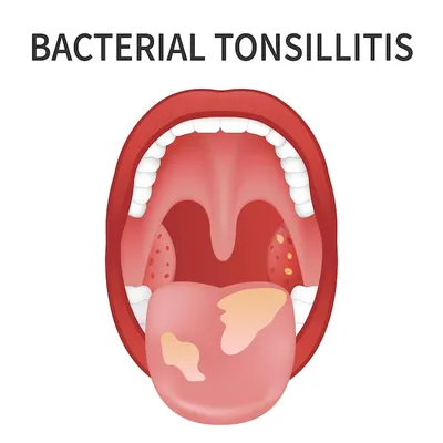 Бактериальный и вирусный тонзиллит ангина фарингит и тонзиллит инфекция  миндалин открытый рот | Премиум векторы