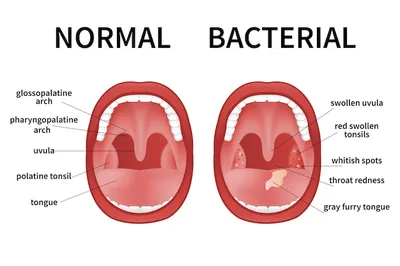 Бактериальный и вирусный тонзиллит ангина фарингит и тонзиллит инфекция  миндалин открытый рот | Премиум векторы