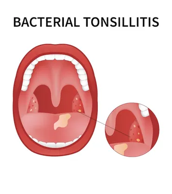 Бактериальный и вирусный тонзиллит ангина фарингит и тонзиллит инфекция  миндалин открытый рот | Премиум векторы