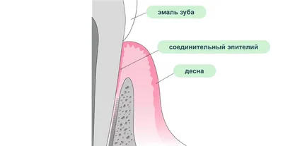 Катаральный гингивит: причины, формы, симптомы, лечение, осложнения