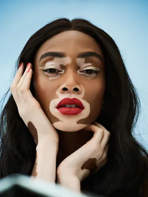 Винни Харлоу (Winnie Harlow) – биография, фото, болезнь витилиго, личная  жизнь, рост и вес 2023 | Узнай Всё