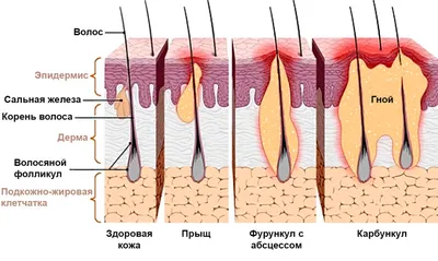 Фурункул кожи: лечение, причины, удаление