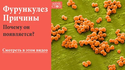 Внутренний фурункул под кожой — особенности лечения, фото образования