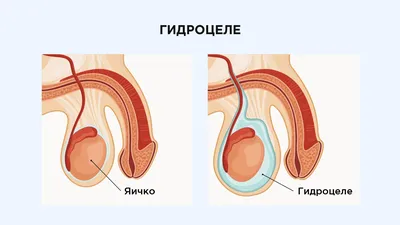 Водянка яичка у ребенка