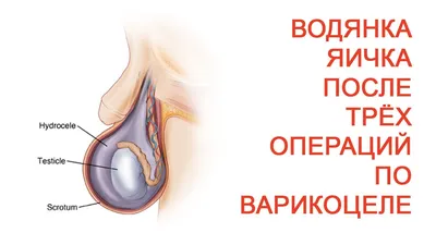 Водянка яичка после трех операций по варикоцеле | Доктор Черепанов