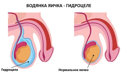 Гидроцеле (водянка яичка) – причины и симптомы, диагностика и лечение у  мужчин