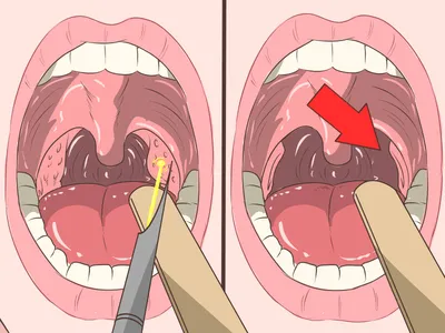 Как избавиться от пробок в миндалинах - wikiHow