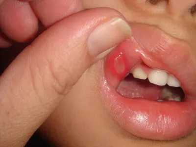 Воспаление слизистой оболочки полости рта, лечение