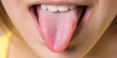 Глоссит: причины и симптомы воспаления языка