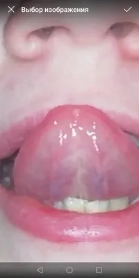 Прозрачное воспаление на кончике языка - Вопрос стоматологу - 03 Онлайн