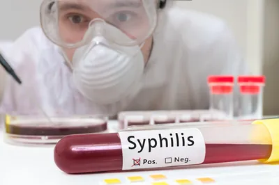 Сифилис: симптомы, признаки, как передается, виды, проявления, лечение