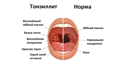 Хронический тонзиллит: симптомы, осложнения, лечение и не только - Лайфхакер