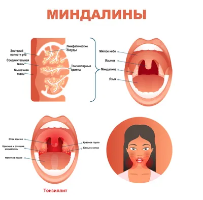 Воспаление миндалин фото