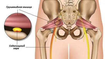 Лечение синдрома грушевидной мышцы в Екатеринбурге - Новая больница