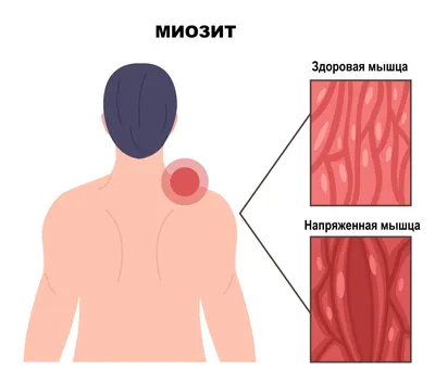 Миозиты - симптомы острой и хронической форм, стадии и признаки у мужчин и  женщин, причины появления, диагностика и лечение заболевания