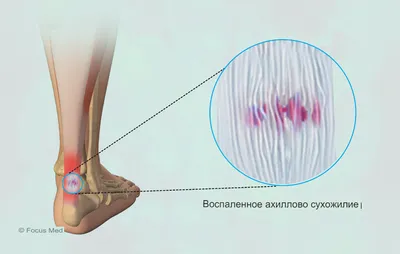 Воспаление Ахиллова сухожилия у пожилых и спортсменов | НОВОСТИ ДОЛГОЛЕТИЯ  (Проспект Гормезиса) | Дзен