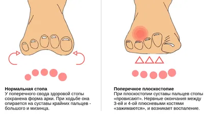 Бурсит – воспаление синовиальной сумки | Статьи клиники Ланцет