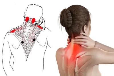Шейный миозит: симптомы и лечение | ЦМРТ: лечебно-диагностические центры |  Дзен