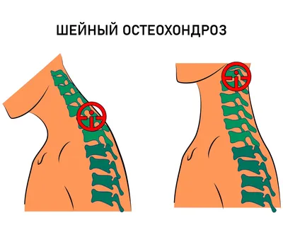 Синдром мышцы, поднимающей лопатку - KinesioPro