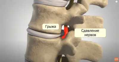 Медичний центр \"Лінія життя\" - Как проявляется миозит (воспаление мышц)?  Чаще всего локальный миозит (поражение одной или нескольких, но не  множества мышц) развивается в мышцах шеи, поясницы, грудной клетки и  голеней. Характерным