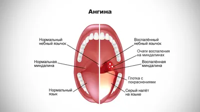 Ангина — причины возникновения, симптомы заболевания, диагностика и лечение  болезни