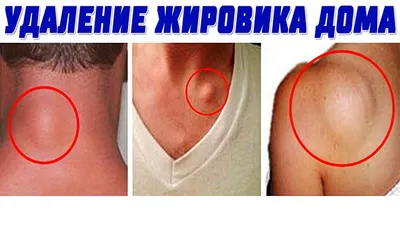 Жировик на шее: как избавится, операция и консервативное лечение, фото  липомы на шее, как снять воспаление