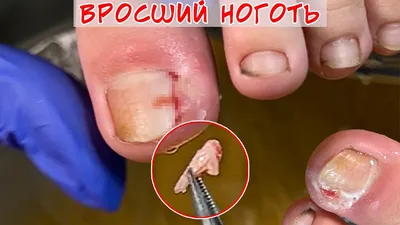 Ingrown nail after injury / Ingrown nail in a child - YouTube