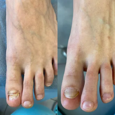 Вросший ноготь, лечение вросшего ногтя в Киеве и Украине, цена на удаление  вросшего ногтя Киев в косметологической клинике Medlas