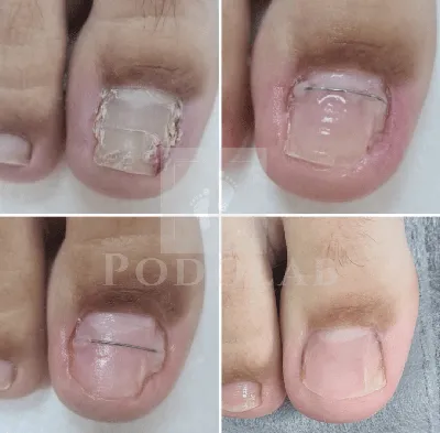 Лечение, удаление вросшего ногтя без хирургии — Центр подологии в PODOLAB  СПБ