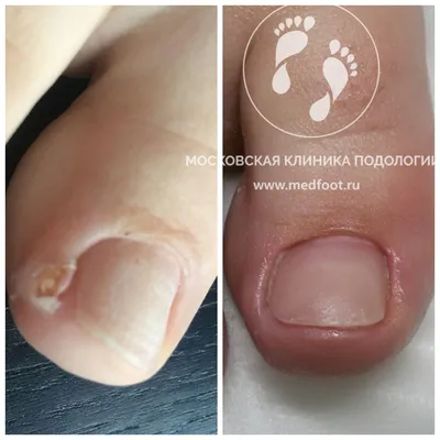 Вросший ноготь лечение | Московская Клиника Подологии