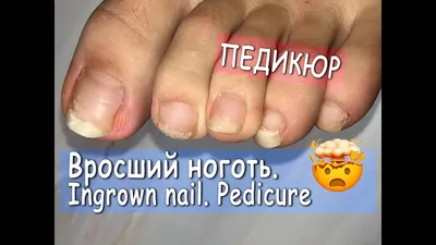 ▻ Pedicure step by step. INGROWN NAIL. How to cut toenails. Pedicure home -  YouTube