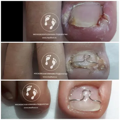 Лечение вросшего ногтя у подолога | Московская Клиника Подологии
