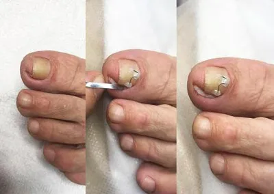 Лечение вросшего ногтя скобами Киев | МЦ SENSAVI