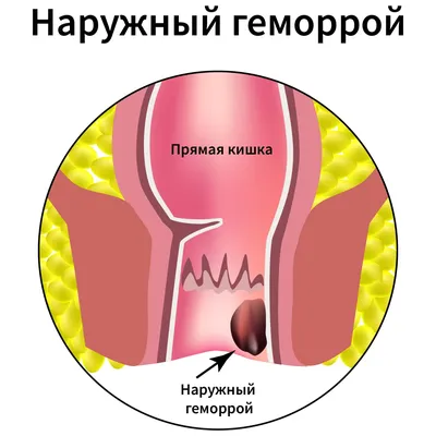 Наружный (внешний) геморрой: симптомы, как выглядит, что делать, лечение,  профилактика