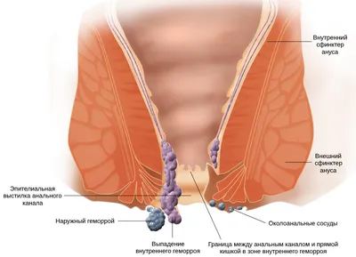 Геморрой — Википедия