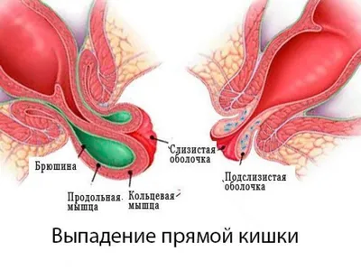 Лечение выпадения прямой кишки в СПб дешево - цены, отзывы