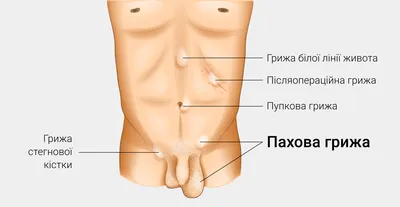 Паховая грыжа у мужчин - КГБУЗ Горбольница №12