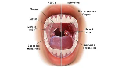 Заболевания горла и гортани как должно выглядеть здоровое горло -  Подольская городская детская поликлиника № 3: статьи