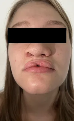 Заячья губа (хейлосхизис) — Екатерина Романова — пластический и  челюстно-лицевой хирург