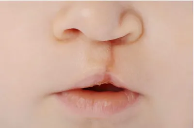 Лечение врожденной расщелины губы (заячьей губы) в Клинике «Константа» в  Ярославле