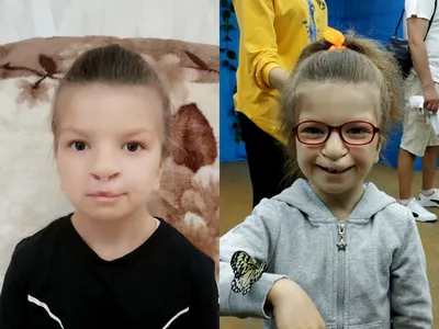 Заячью губу и другие врожденные дефекты лица у детей успешно лечат в  Охматдете в Киеве - «ФАКТЫ»