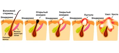 Комедоны на лице: удаление, лечение