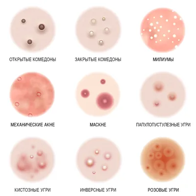 Виды прыщей на лице, что они означают и способы борьбы с ними