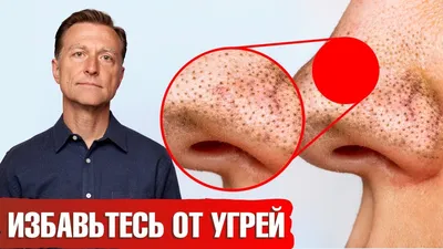 Достали комедоны? Исключи эти продукты и угри пройдут навсегда🙌 - YouTube