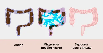 ᐈ Лечение запоров у взрослых ~【Причины и симптомы】